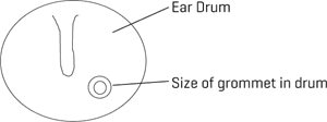 Glue-Ear